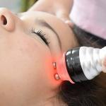 Radio Frequency treatment on the face for skin tightening.