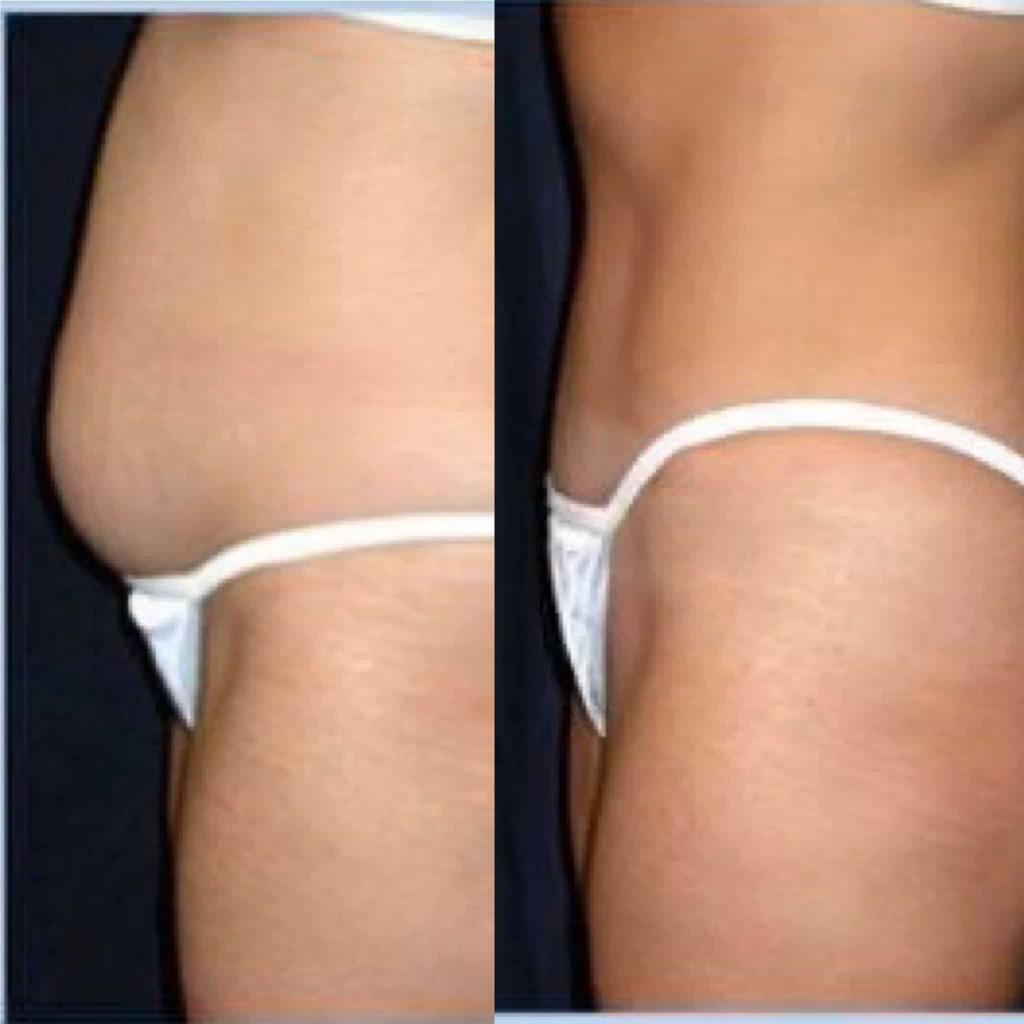 Cavitation before and after photographs