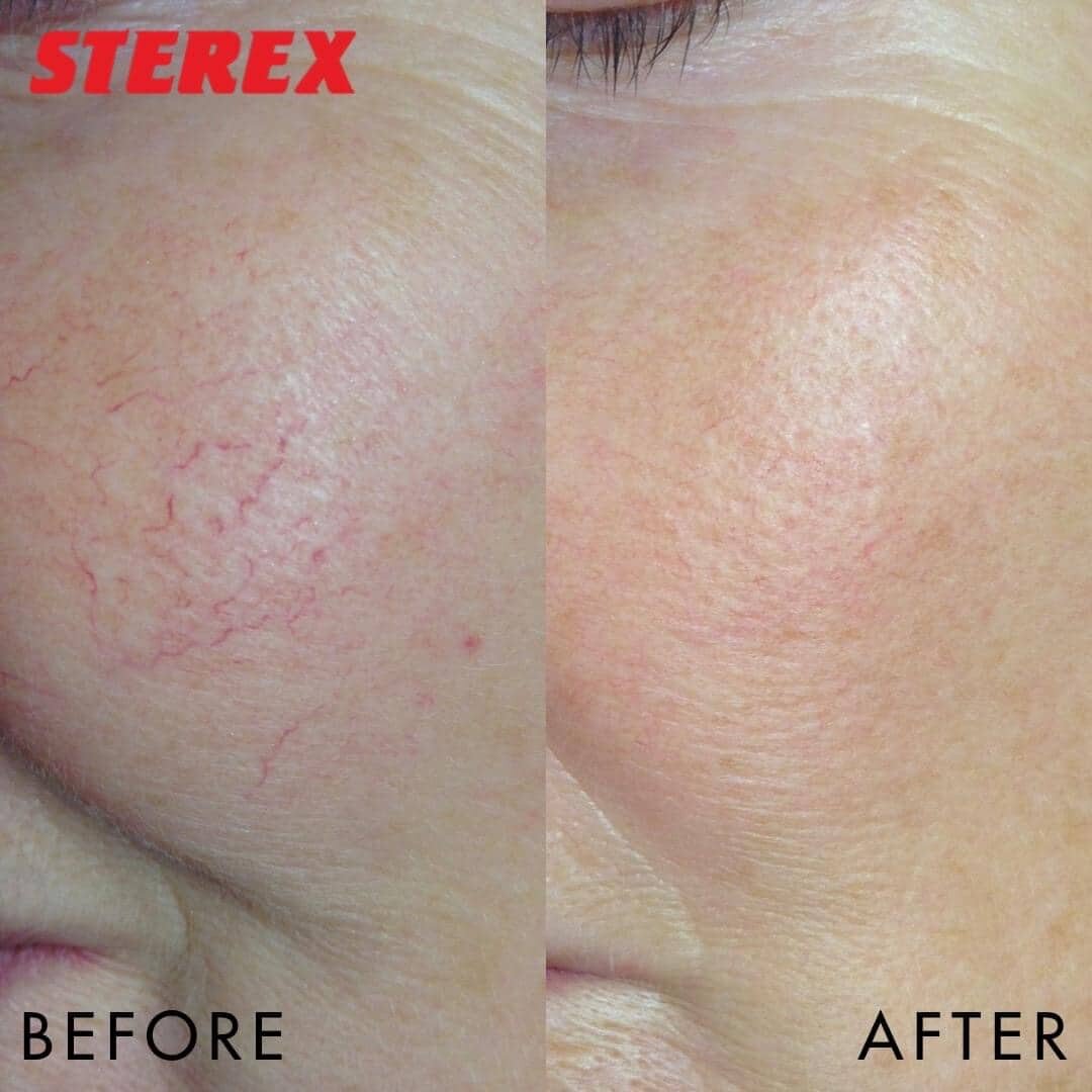 Thread Veins The Skinologist